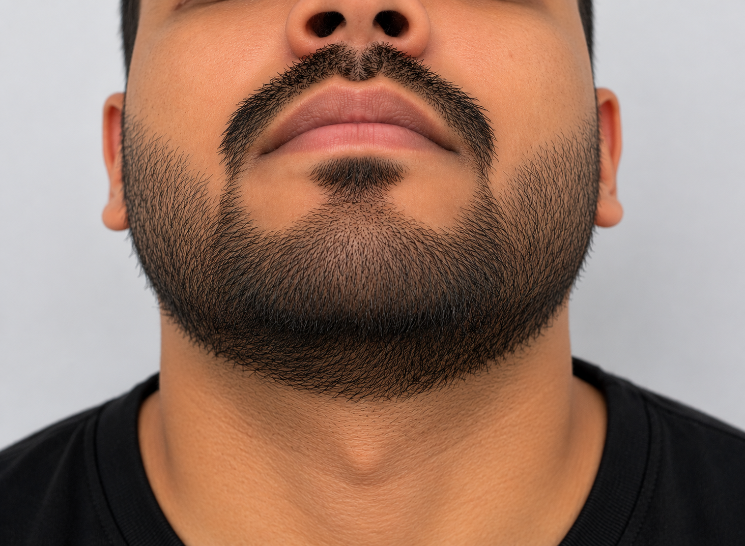 Beard Transplantation after result