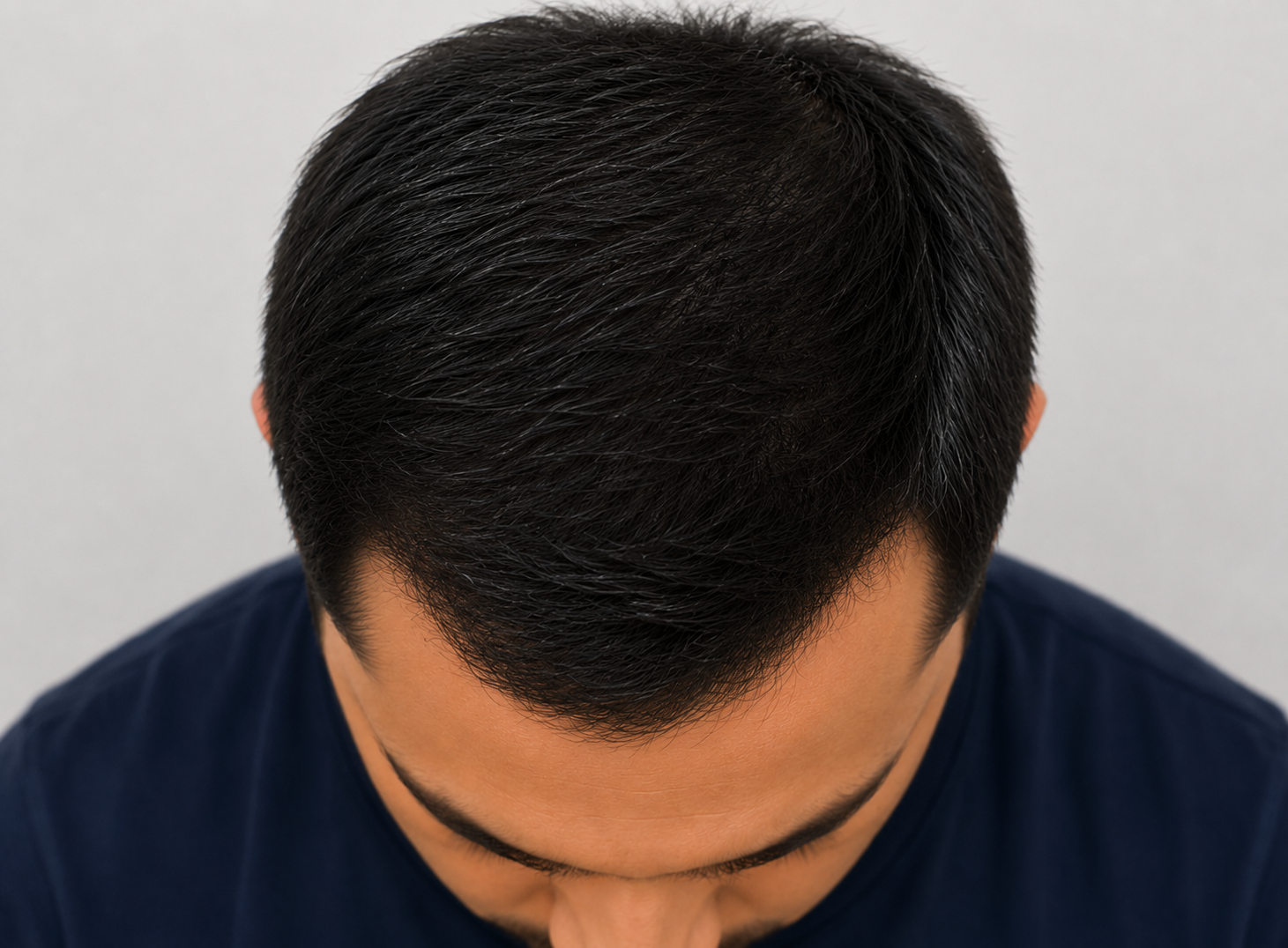 PRP GFC Hair Treatment after result