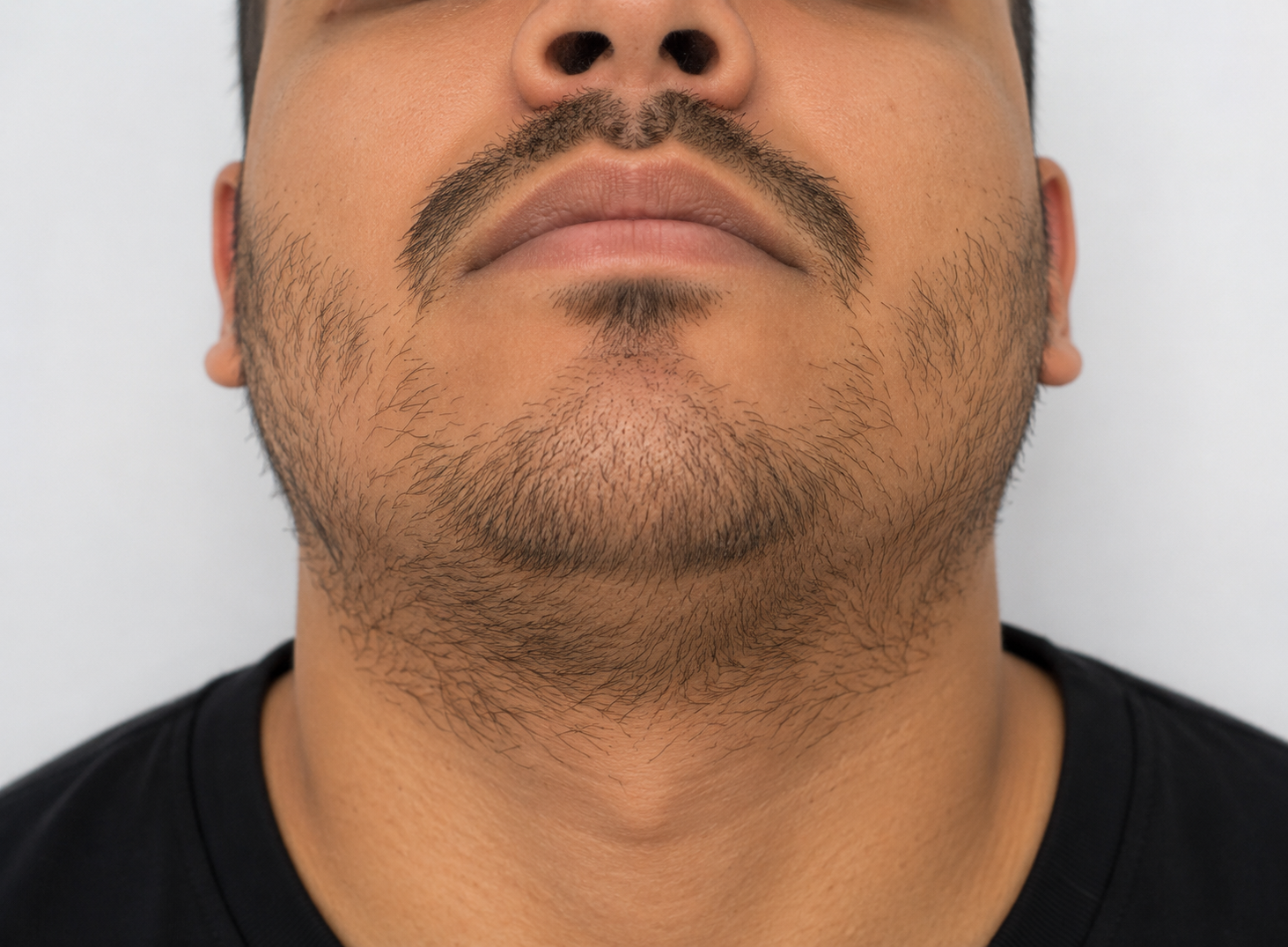 Beard Transplantation before result