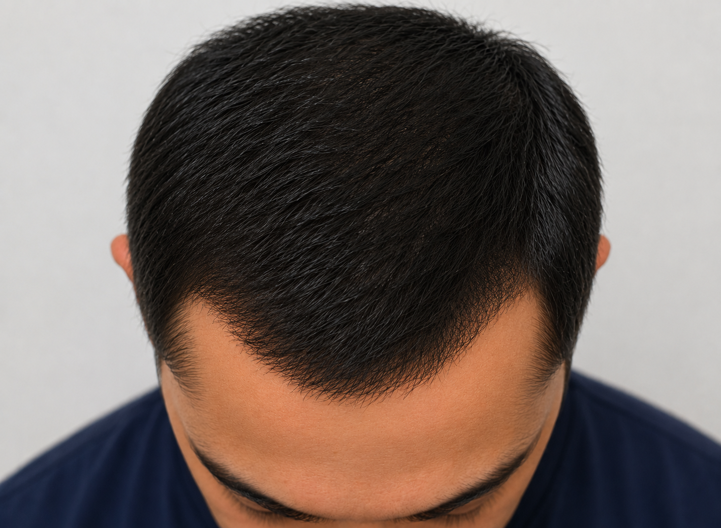 Hair Transplantation after result